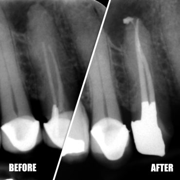 Sclerosed Canals
