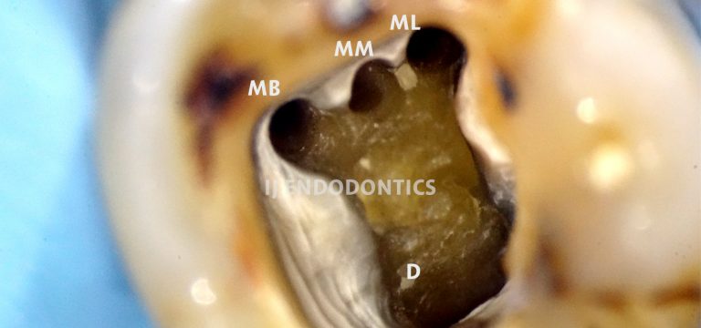 Middle Mesial canal