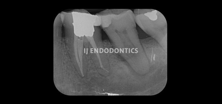 Post op middle mesial