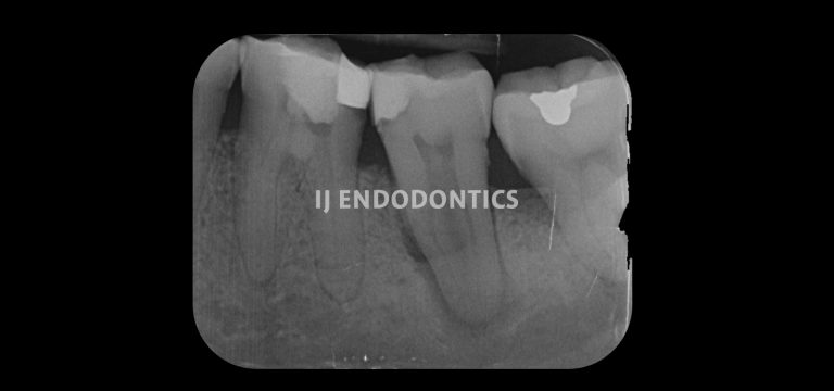 Pre-op LL6
