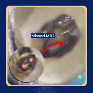 missed MB2