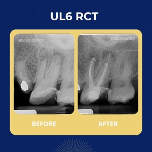 UL6 RCT