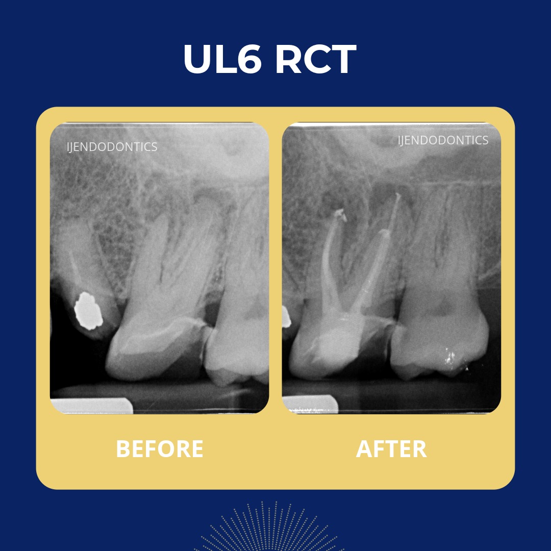 UL6 RCT